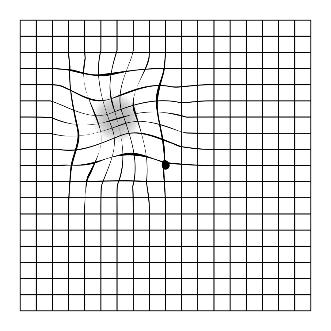 distorted amsler grid lines