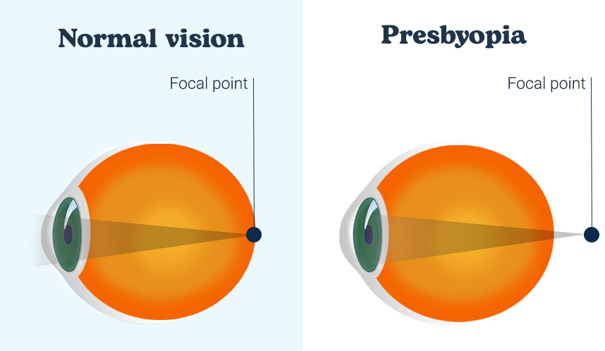 image of focal point in normal eye and in eye with presbyopia