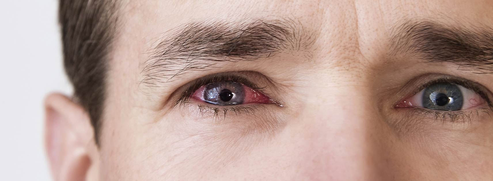 Eye margin inflammation