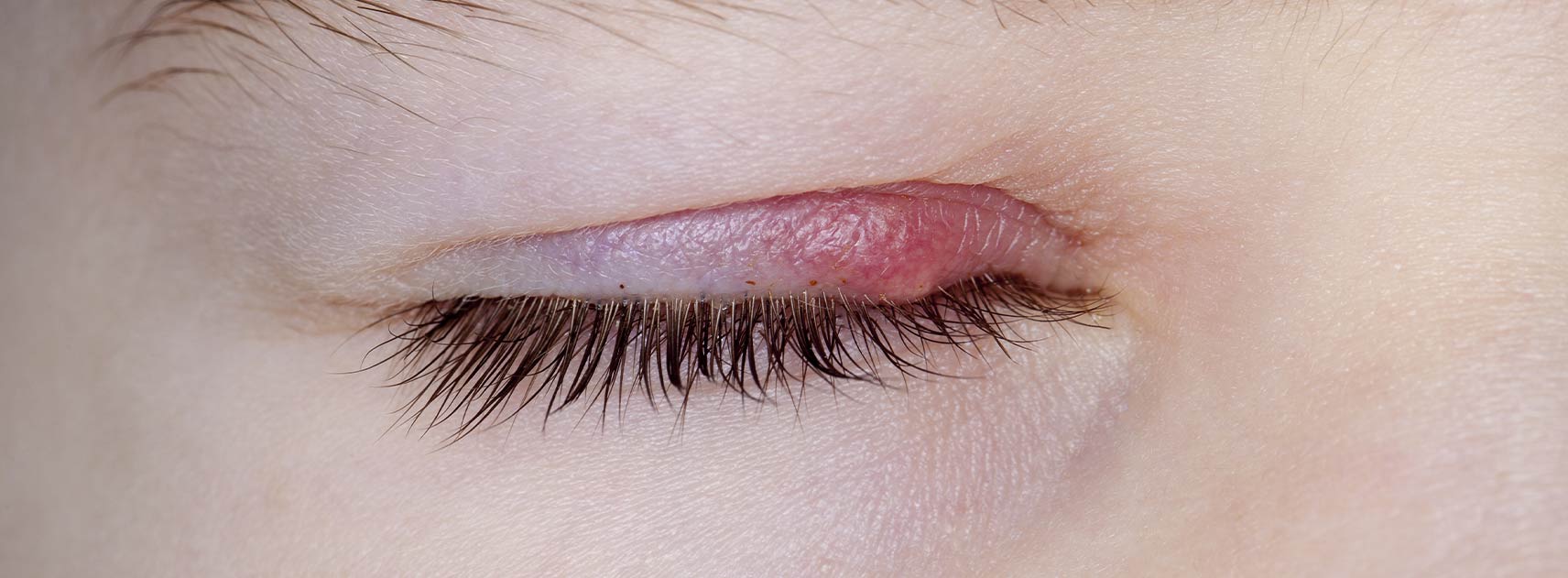 Eyelid with stye