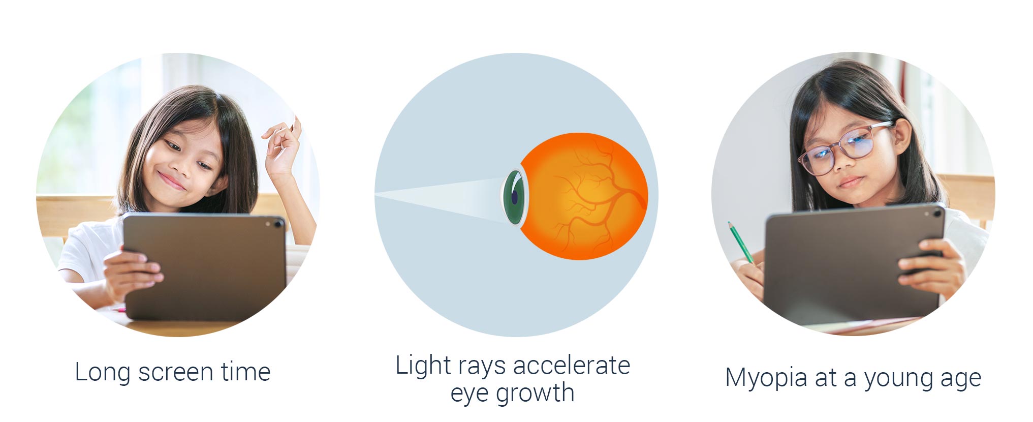 What causes Myopia in children?