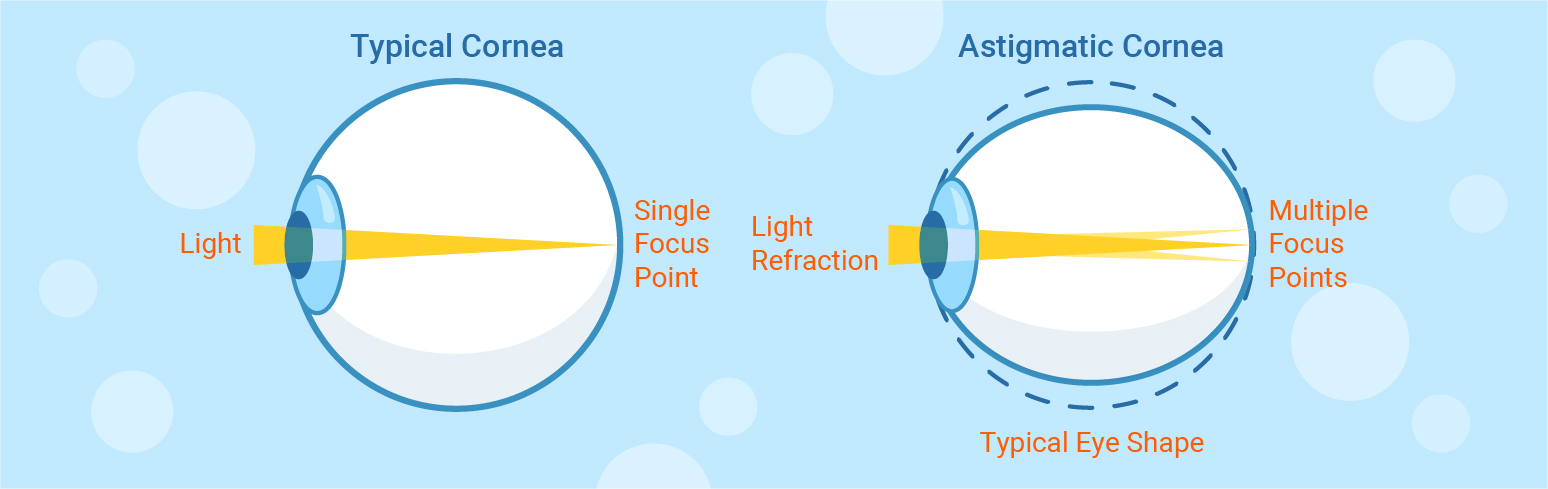 typisk och astigmatism hornhinnan