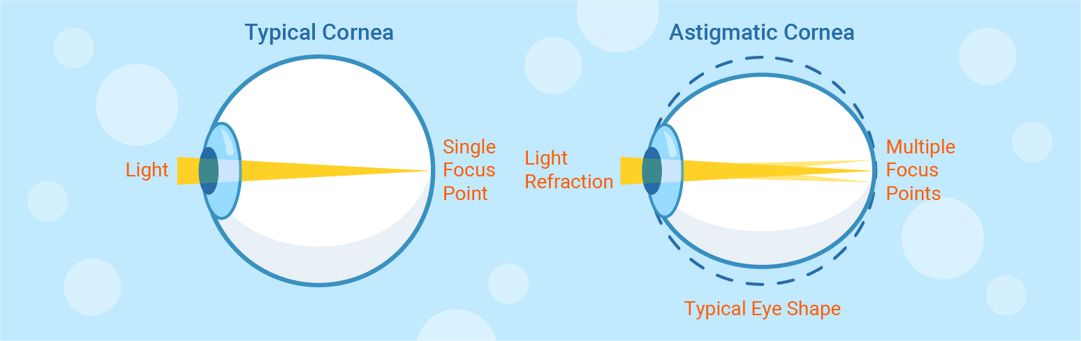 typical and astigmatism cornea